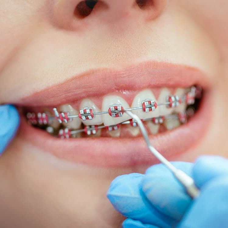 Ортодонтія - брекети та виправлення прикусу